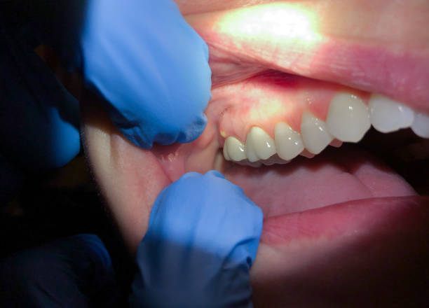 Best Emergency Gum Pain Relief  in Jnstown, OH